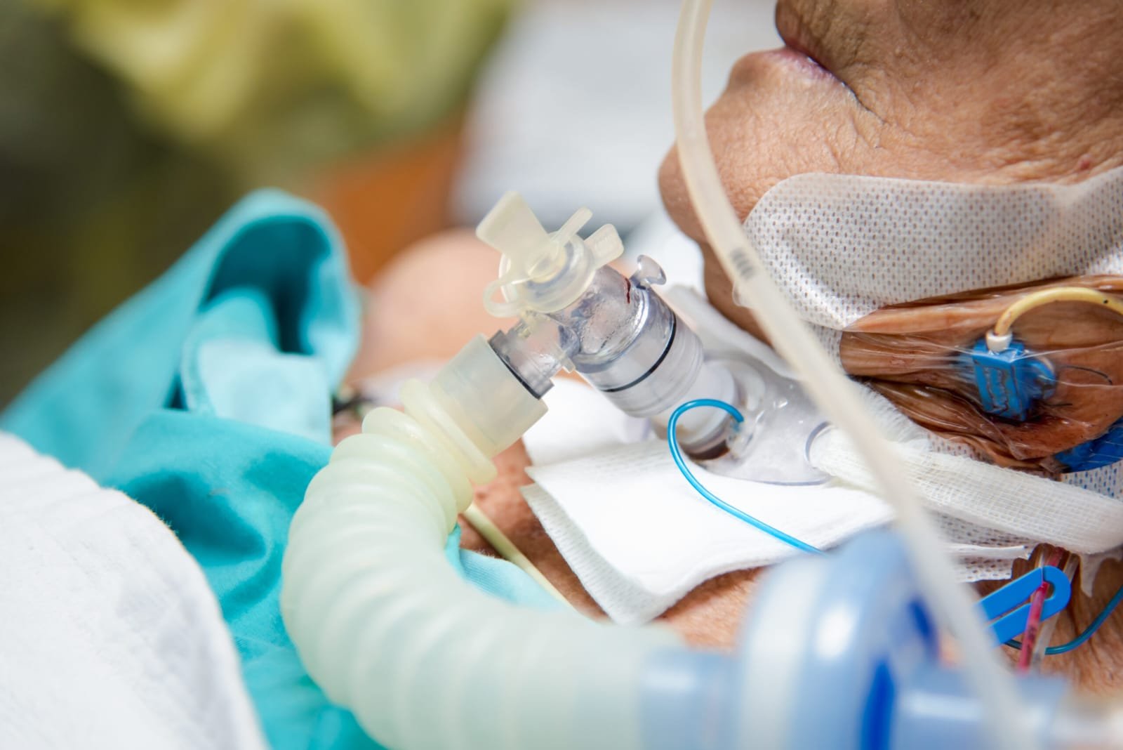 Tracheostomy